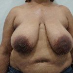 Breast Reduction Before & After Patient #1181