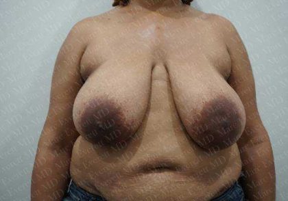 Breast Reduction Before & After Patient #1181