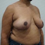Breast Reduction Before & After Patient #1181