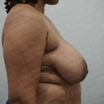 Breast Reduction Before & After Patient #1181