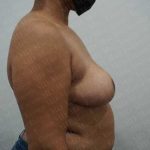 Breast Reduction Before & After Patient #1181