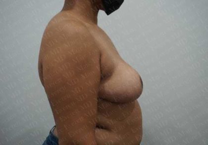 Breast Reduction Before & After Patient #1181