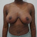 Breast Reduction Before & After Patient #1179