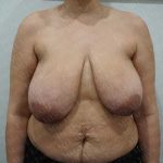 Breast Reduction Before & After Patient #1178