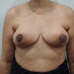 Breast Reduction Before & After Patient #1178