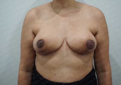 Breast Reduction Before & After Patient #1178