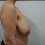 Breast Reduction Before & After Patient #1178