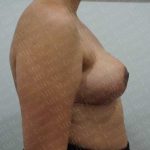 Breast Reduction Before & After Patient #1178