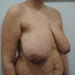 Breast Reduction Before & After Patient #1178