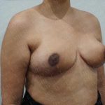 Breast Reduction Before & After Patient #1178