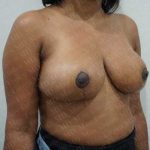 Breast Reduction Before & After Patient #1145