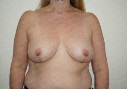 Breast Reduction Before & After Patient #1144