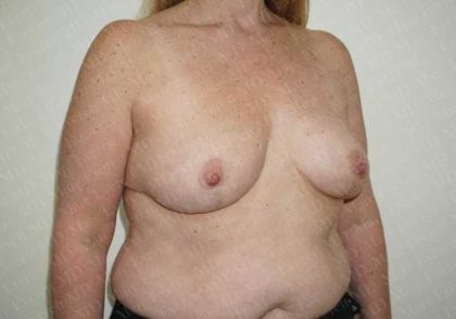 Breast Reduction Before & After Patient #1144