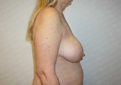 Breast Reduction Before & After Patient #1144
