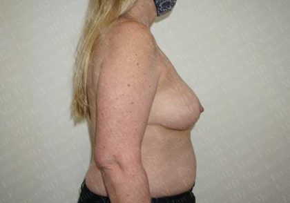Breast Reduction Before & After Patient #1144