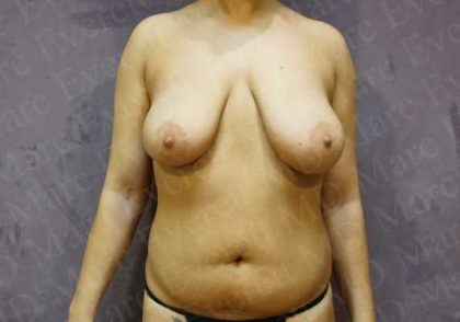 Breast Reduction Before & After Patient #1143