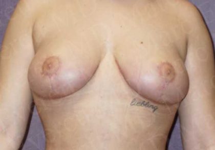 Breast Reduction Before & After Patient #1143
