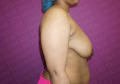 Breast Lift Before & After Patient #1126