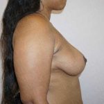 Breast Lift Before & After Patient #1126
