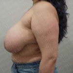 Breast Reduction Before & After Patient #1124