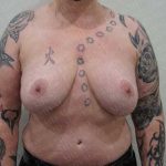 Breast Reduction Before & After Patient #1123