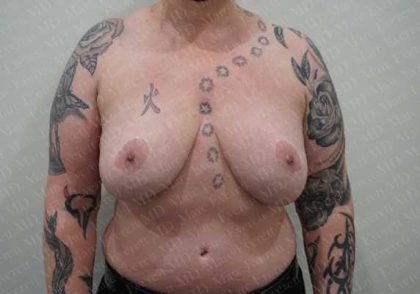 Breast Reduction Before & After Patient #1123