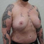 Breast Reduction Before & After Patient #1123