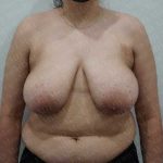 Breast Reduction Before & After Patient #1100