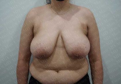 Breast Reduction Before & After Patient #1100