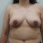 Breast Reduction Before & After Patient #1100