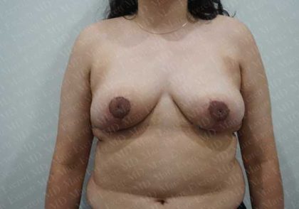 Breast Reduction Before & After Patient #1100