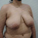 Breast Reduction Before & After Patient #1100