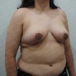 Breast Reduction Before & After Patient #1100