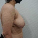 Breast Reduction Before & After Patient #1100