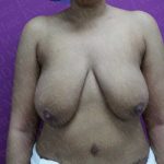 Breast Reduction Before & After Patient #1099