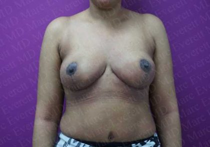 Breast Reduction Before & After Patient #1099