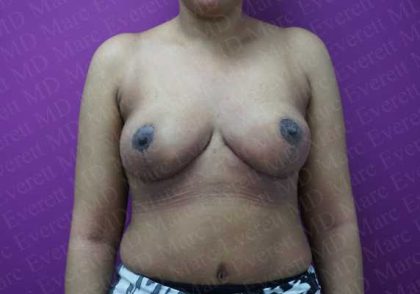 Breast Reduction Before & After Patient #1099