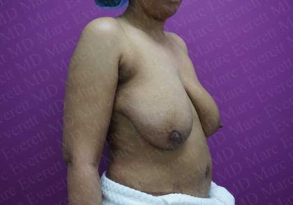 Breast Reduction Before & After Patient #1099