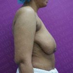 Breast Reduction Before & After Patient #1099