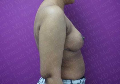 Breast Reduction Before & After Patient #1099