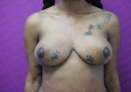 Breast Reduction Before & After Patient #1097