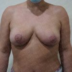 Breast Reduction Before & After Patient #1057