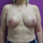 Breast Reduction Before & After Patient #1056