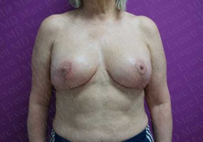 Breast Reduction Before & After Patient #1056