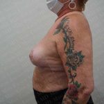 Breast Reduction Before & After Patient #1054
