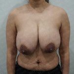 Breast Reduction Before & After Patient #1504