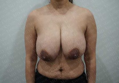 Breast Reduction Before & After Patient #1504