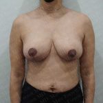 Breast Reduction Before & After Patient #1504