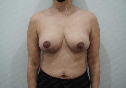 Breast Reduction Before & After Patient #1504