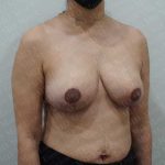 Breast Reduction Before & After Patient #1504
